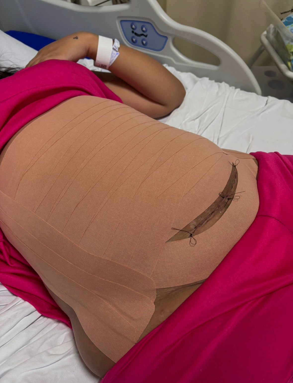 Bandagem kinesio taping para suporte gestacional - Petrópolis